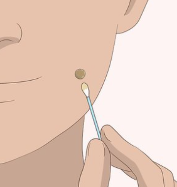 How to Remove Moles Safely Without Damaging Your Skin: Treatments & Tips